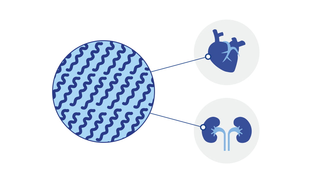 Detailansicht von Amyloidfibrillen in den Organen Herz und Nieren bei AL-Amyloidose