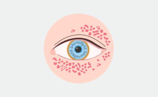 Rote Punkte rund um den Augenbereich, welche Hauteinblutungen darstellen