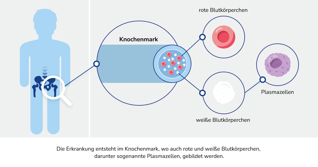 Entstehung von AL-Amyloidose im Knochenmark, wo rote und weiße Blutkörperchen, darunter Plasmazellen, gebildet werden
