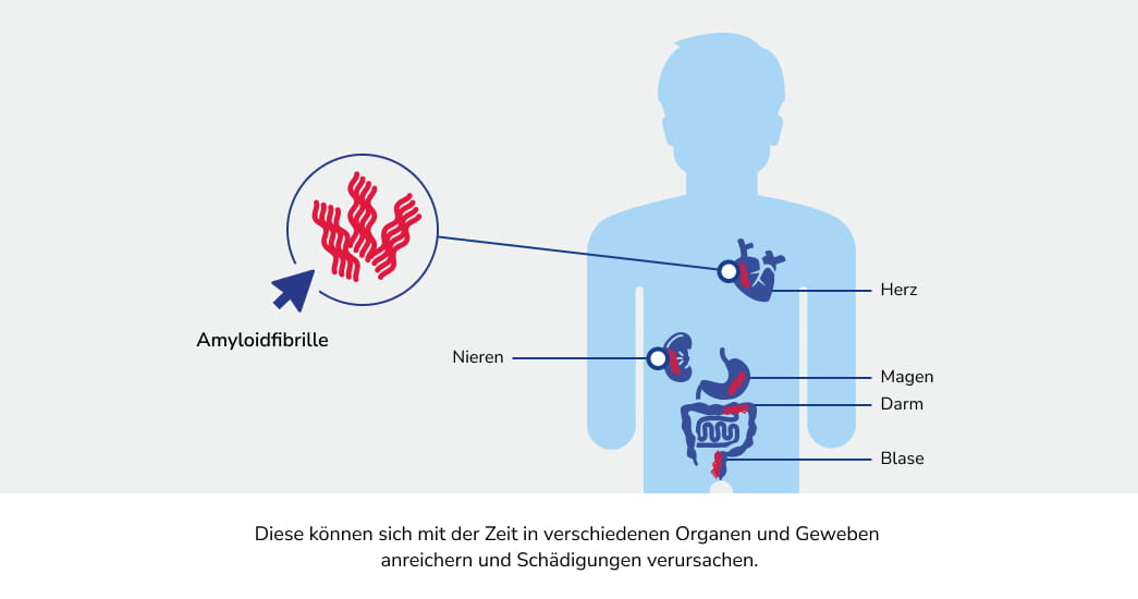 Anreicherung Amyloidfibrillen bei AL-Amyloidose in Herz, Nieren, Magen, Darm oder Blase