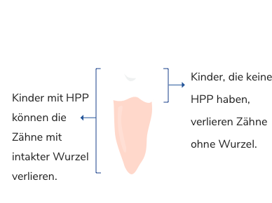 Kinder mit HPP können Zähne mit intakter Wurzel verlieren. Kinder, die keine HPP haben, verlieren Zähne mit Wurzel.