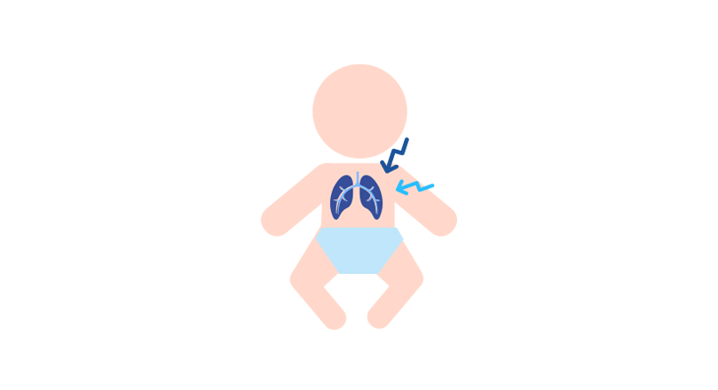 Säugling mit unterentwickelter Lunge