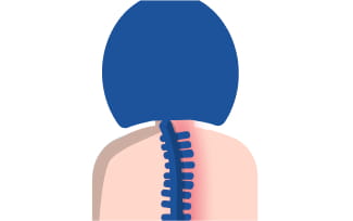 Patientin mit entzündetem Rückenmark