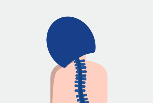 Patientin mit seitlich geneigtem Kopf, symbolisch für Kopfhalteschwäche